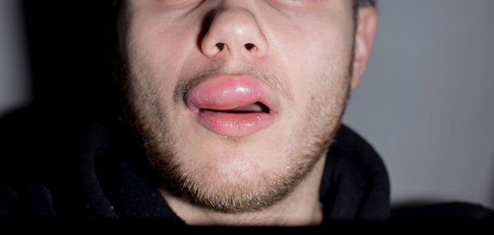 Angioedema