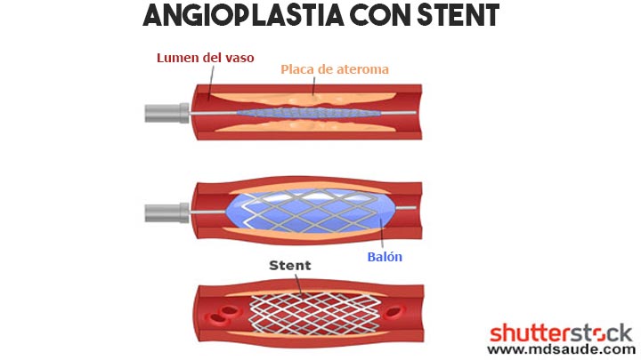 Angioplastia con stent