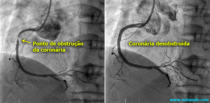Angioplastia coronária (antes e depois)