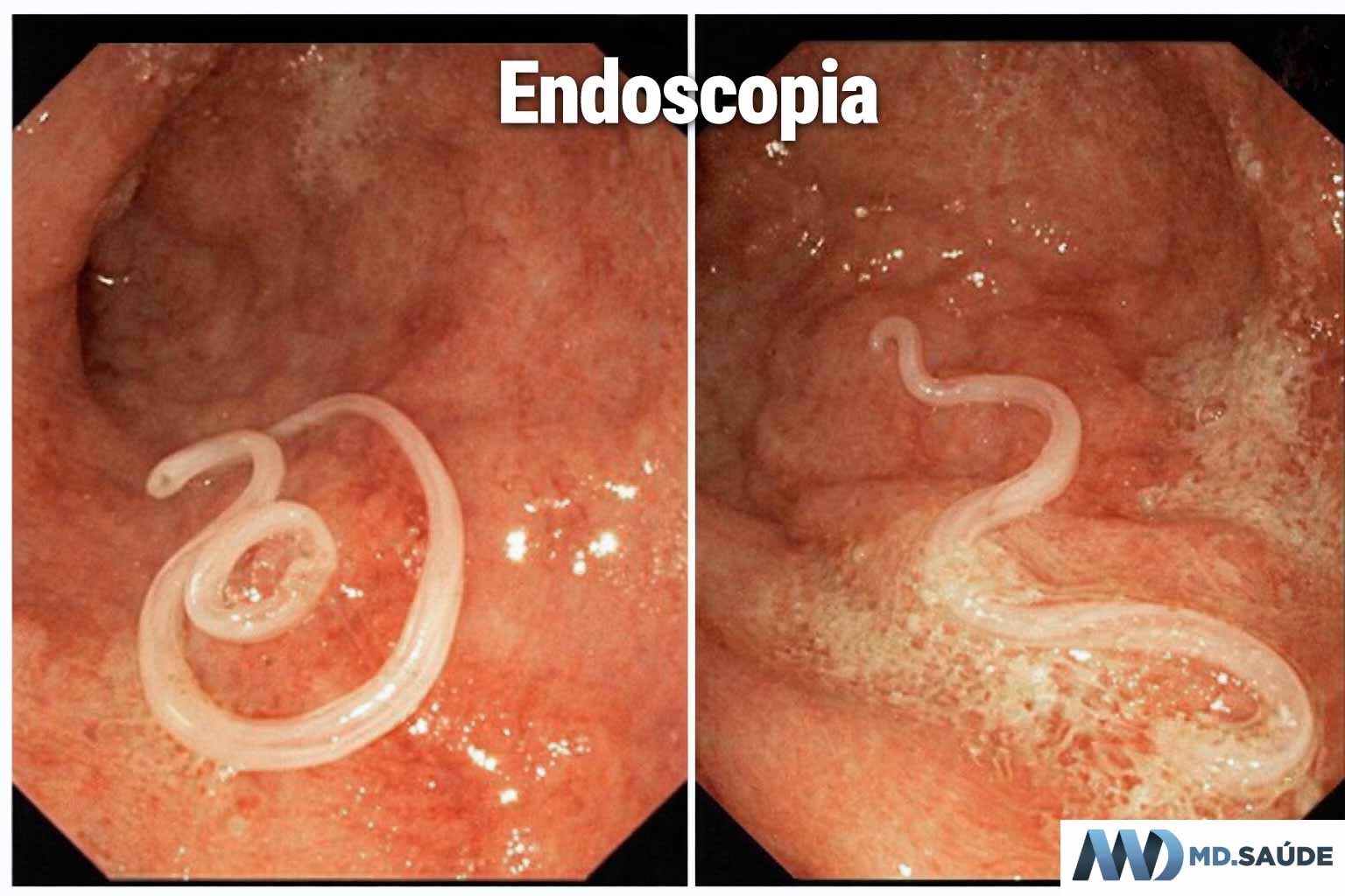 Anisakis identificado em uma endoscopia digestiva