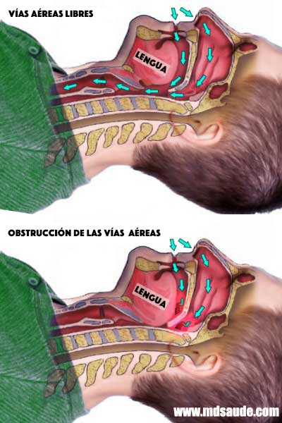 apnea del sueño