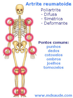 Articulações mais acometidas pela artrite reumatoide