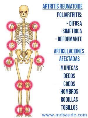 Articulaciones afectadas en la artritis reumatoide