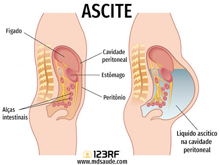 Ascite
