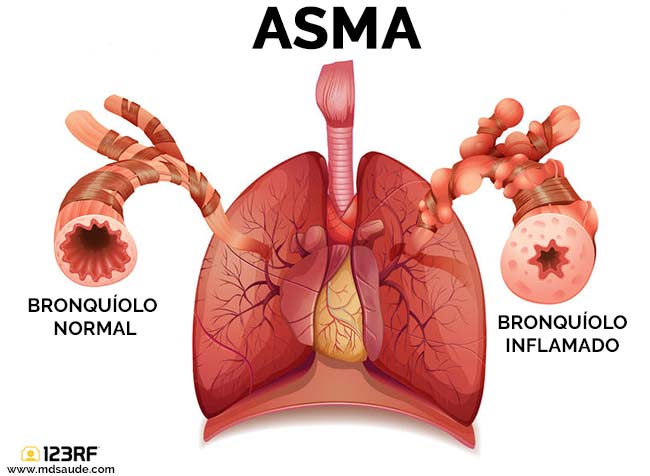 Pulmão com asma