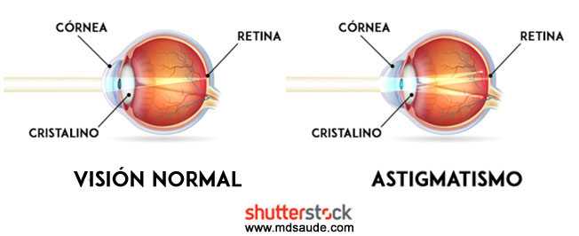 Astigmatismo