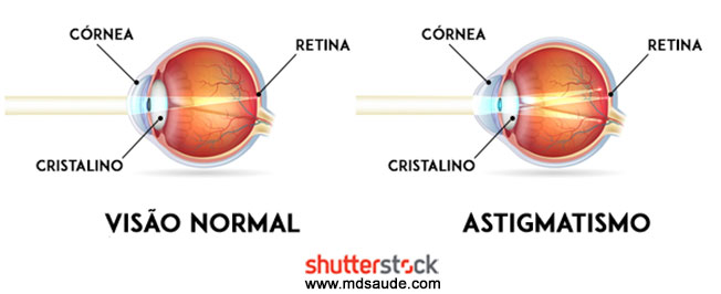 Como surge o astigmatismo