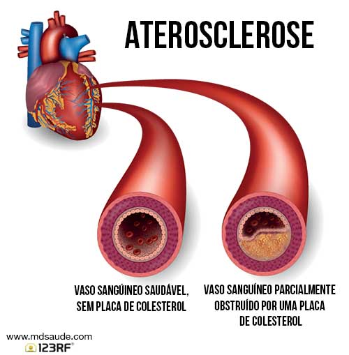 Aterosclerose