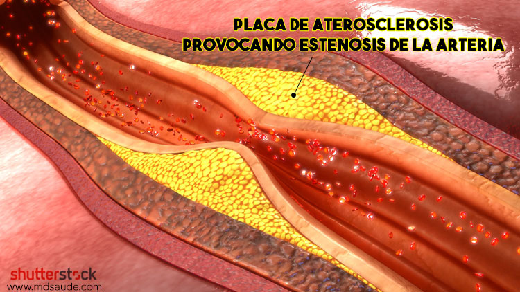 Placa de aterosclerosis