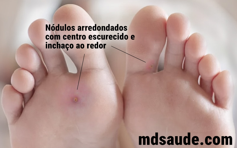 Foto de bicho-do-pé.