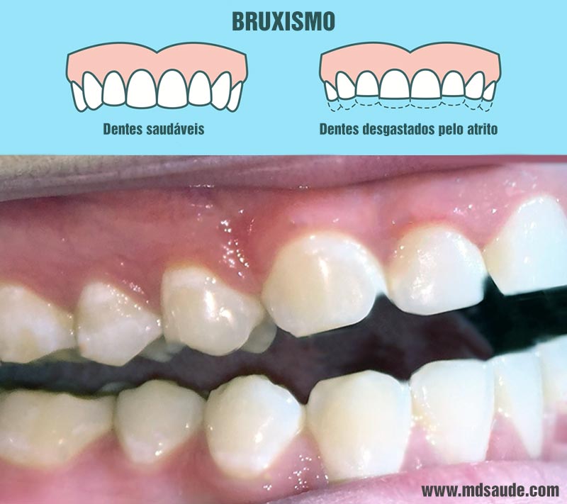 Bruxismo: desgaste dos dentes