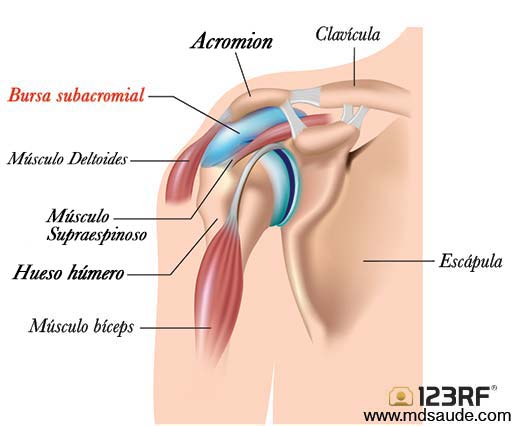 Bursitis