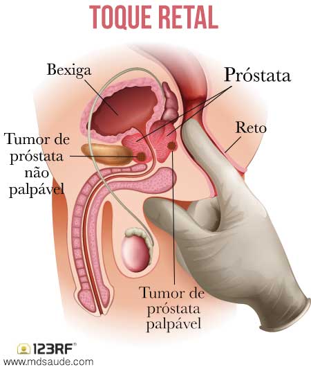 Toque retal - câncer de próstata