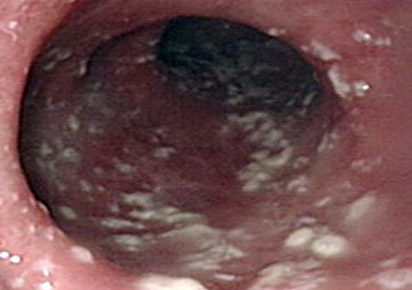 Candidíase de esôfago (vista por endoscopia)