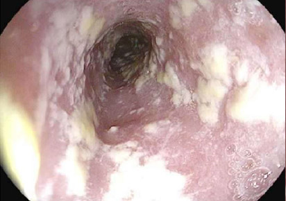Candidíase de esôfago (vista por endoscopia)