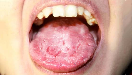 Candidiasis en la lengua del ninõ
