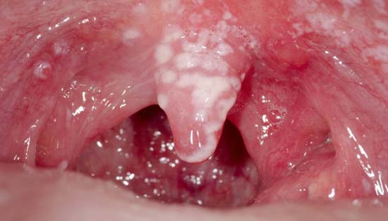 Candidiasis oral (algodoncillo)