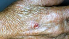 Carcinoma espinocelular