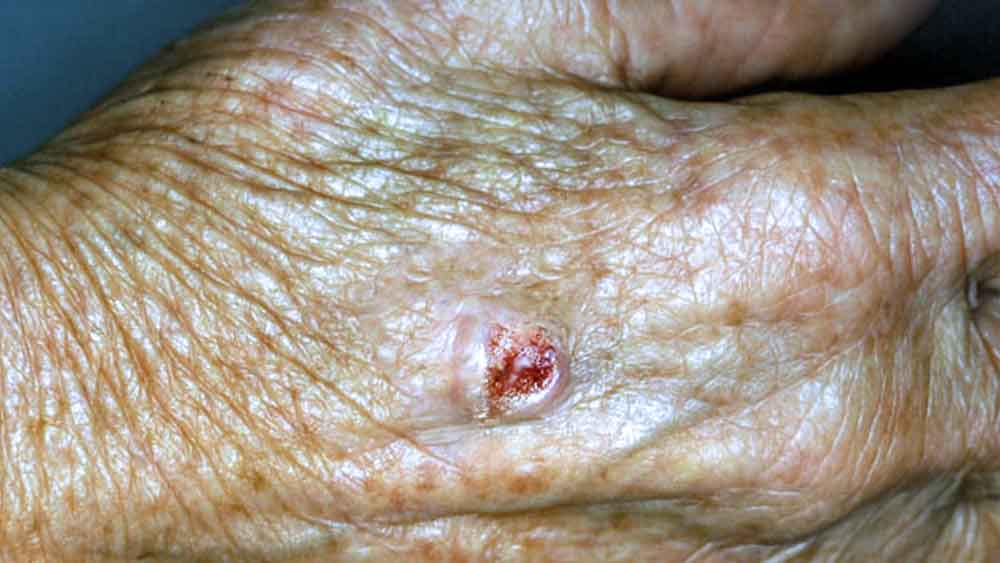 Carcinoma espinocelular