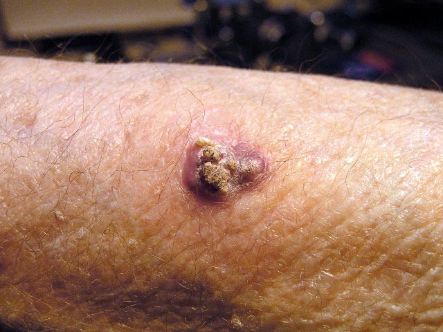 Carcinoma espinocelular da pele