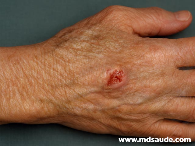 Lesão ulcerativa na mão - carcinoma espinocelular da pele