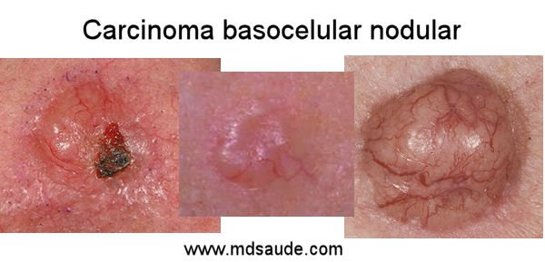 carcinoma basocelular nodular