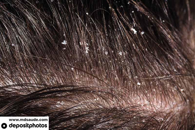 Caspa en el cabello