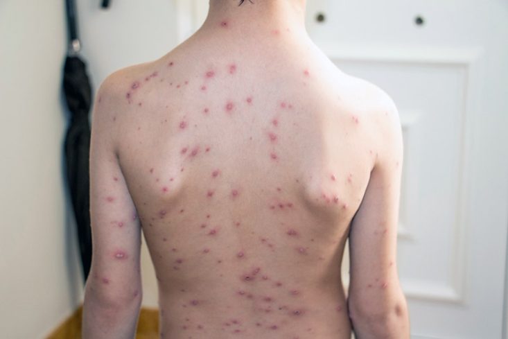 Erupção da catapora: pápulas, vesículas, pústulas e crostas espalhadas pelo corpo