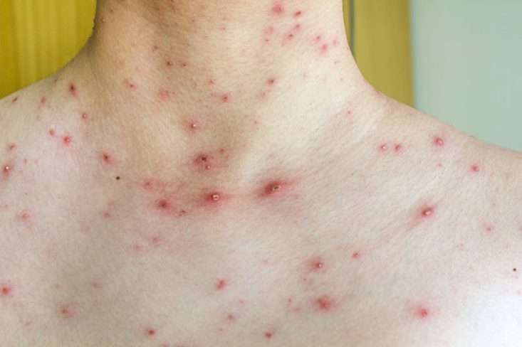 Varicela com pápulas, pústulas e algumas crostas