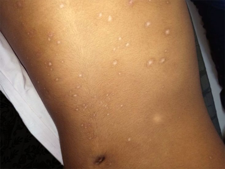 Hipopigmentação após cura da varicela