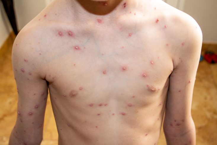 Varicela com múltiplas pústulas, algumas pápulas e crostas.
