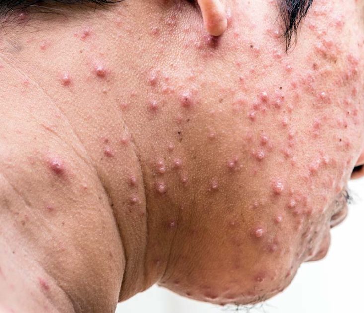 Lesões da varicela na face de um adulto