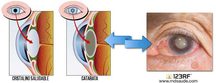 Catarata - Opacificación del cristalino