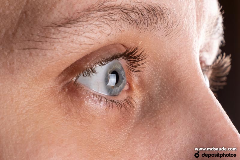 Ceratocone ocular