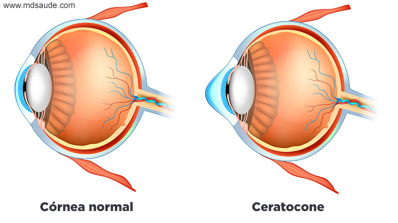 Córnea normal x córnea com ceratocone