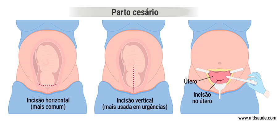 Incisão cirúrgica na cesariana