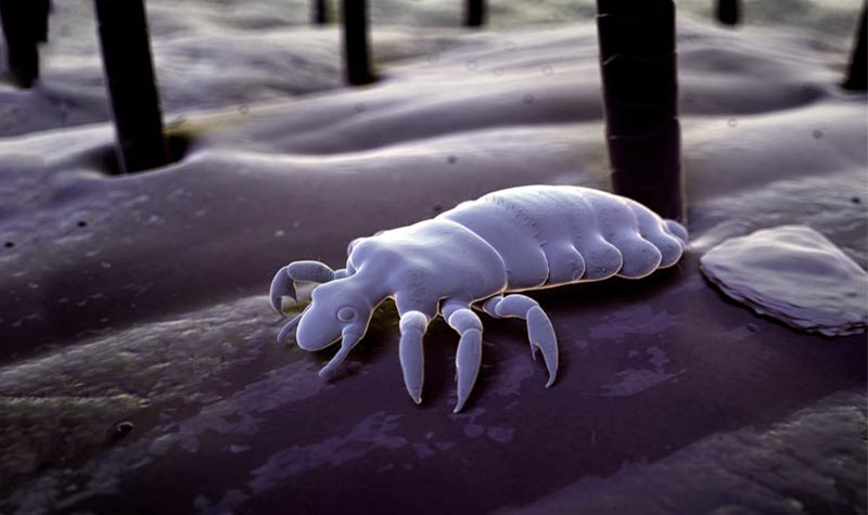 pediculosis púbica
