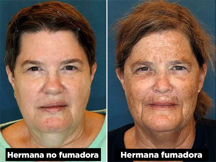 Hermanas gemelas idénticas: la de la derecha es fumadora; la de la izquierda nunca fumó.