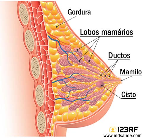 Cisto mamário