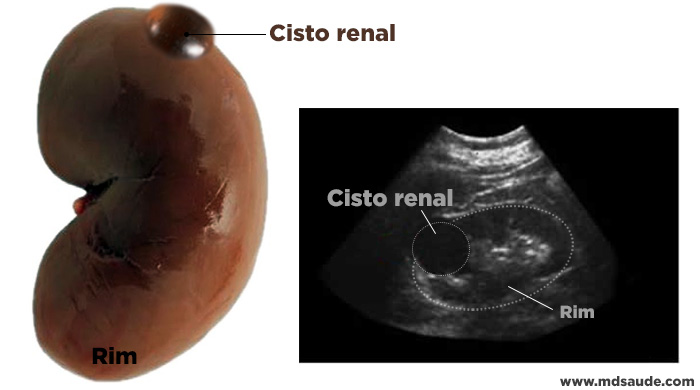 Aparência de um cisto renal