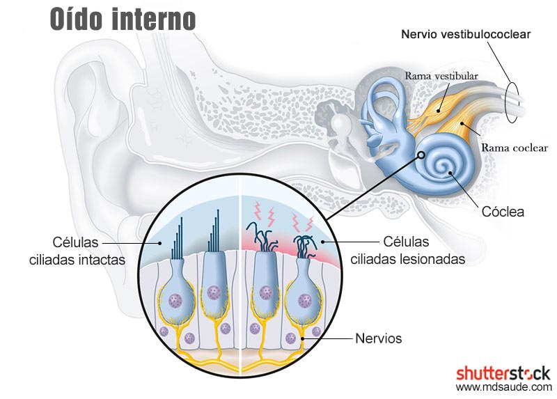 Oído interno - Daño en las células ciliadas de la cóclea