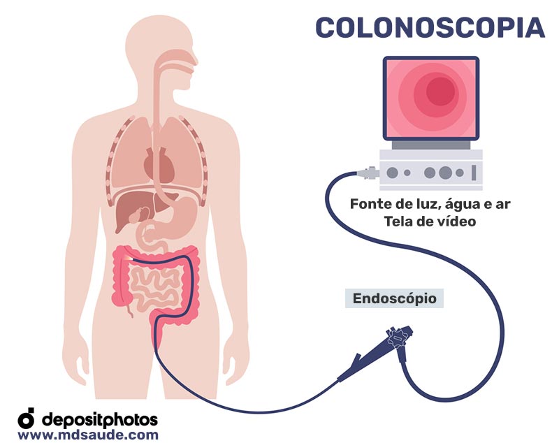 Colonoscopia - Ilustração
