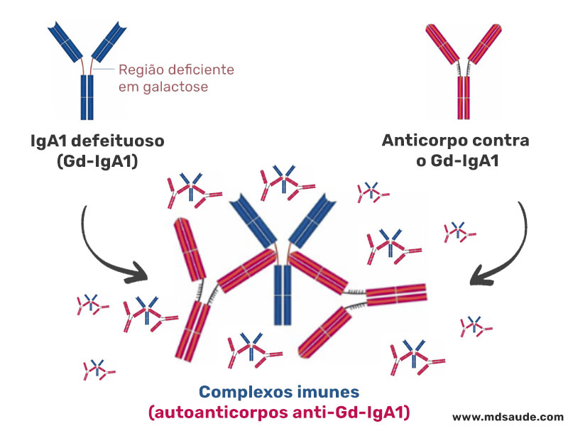 Complexos imunes (autoanticorpos anti-Gd-IgA1)