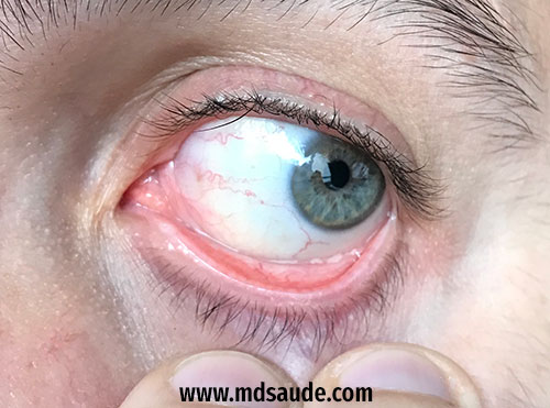 conjuntiva