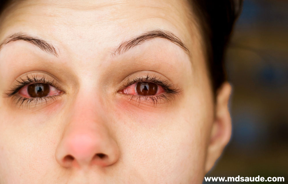 Conjuntivite alérgica: olhos vermelhos, lacrimejamento e rinite
