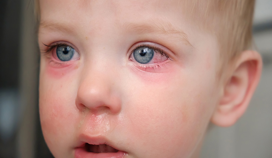Conjuntivite alérgica acomentendo os dois olhos, em criança com rinite