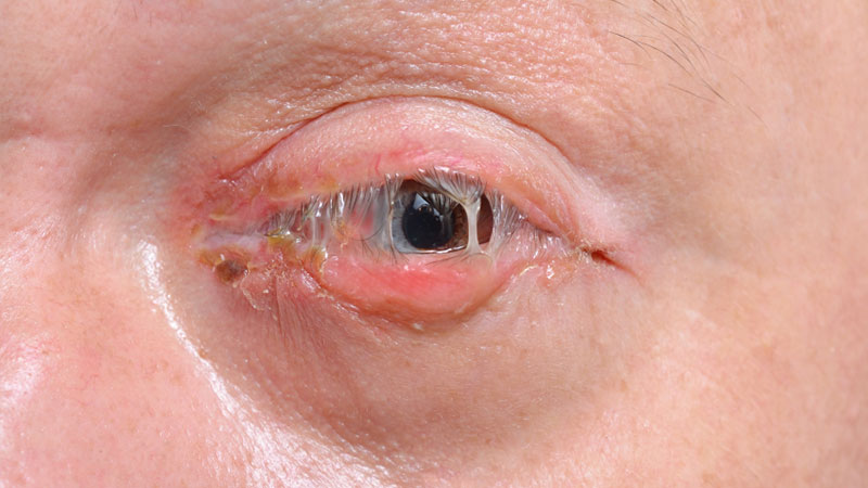 Conjuntivite bacteriana - Olhos inchados, vermelhos e com secreção purulenta