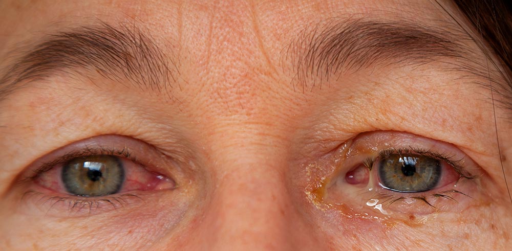 Conjuntivite bacteriana com intensa secreção amarelada, edema conjuntival e vermelhidão