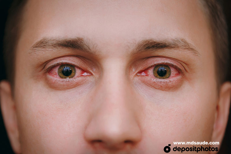 Conjuntivitis alérgica bilateral