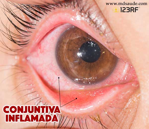 Conjuntivitis